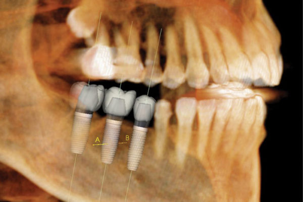 Plymouth Dental Implant Dentists