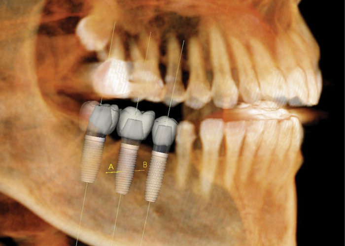 Plymouth Dental Implant Dentists