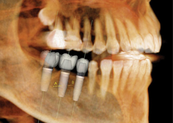Plymouth Mi Dental Implant Dentists