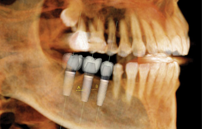 Plymouth MI Dental Implant Dentists