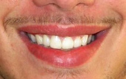 Teeth Whitening Dentist Plymouth