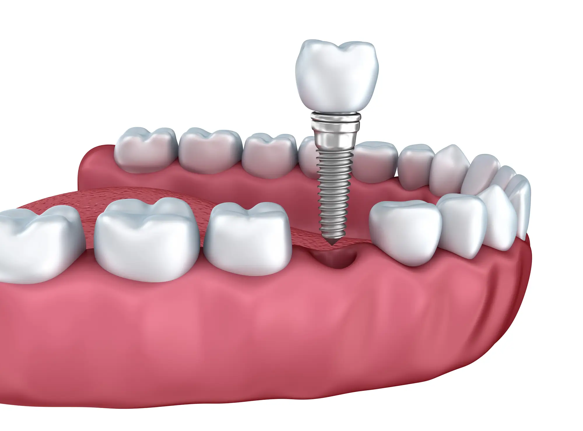 Close Up Of Lower Teeth With Dental Implants In Plymouth