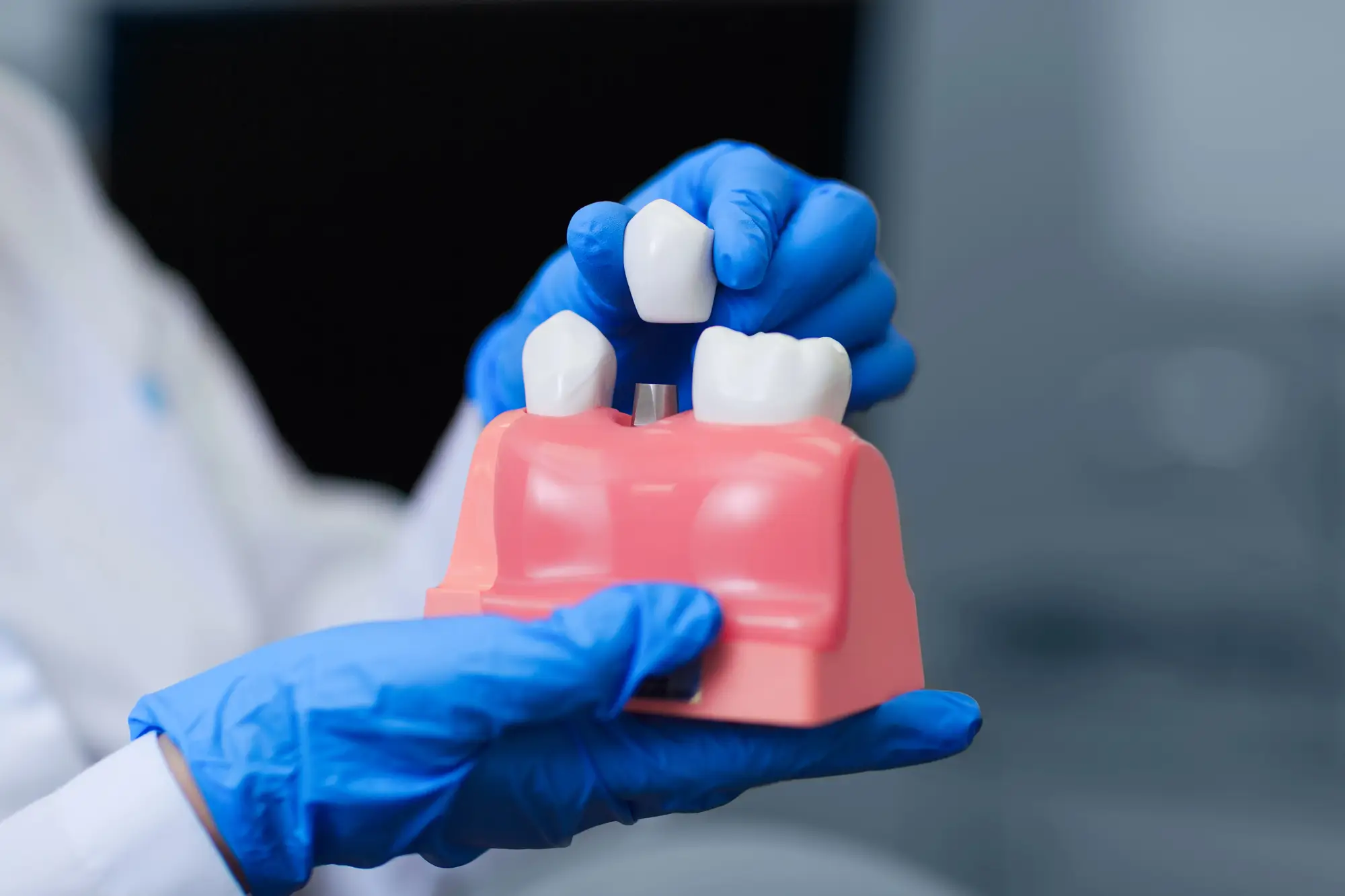 Dentist Explaining Dental Implants In Plymouth With A Tooth Model